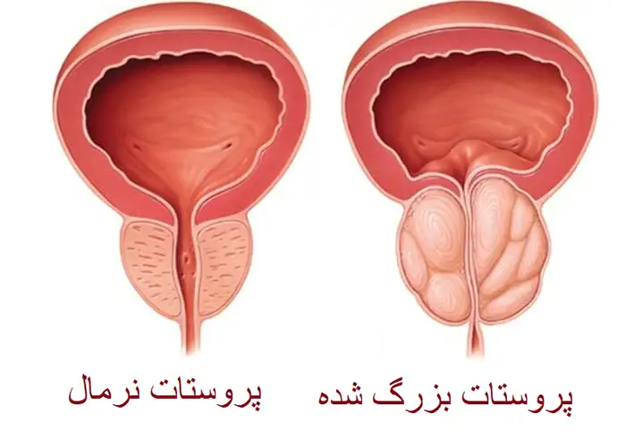 مرکزخرید بره موم طبیعی باضمانت-درمان پروستات - قره داغ