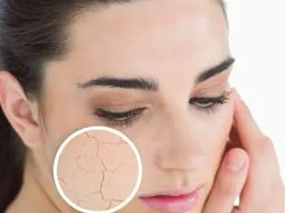 عسل طبیعی برای درمان