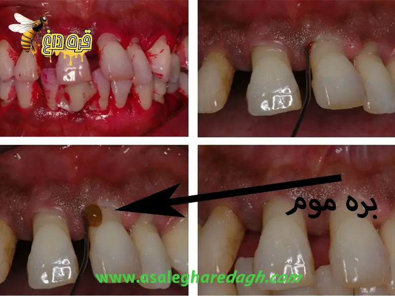 خاصیت بره موم زنبورعسل